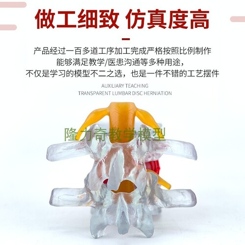 인체 모형  요추간판 압시연 모델 척추골병리측-624144