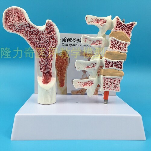 인체 모형 대퇴골 골다공증 해부 모형 다리뼈 척추절단면 표본-624138